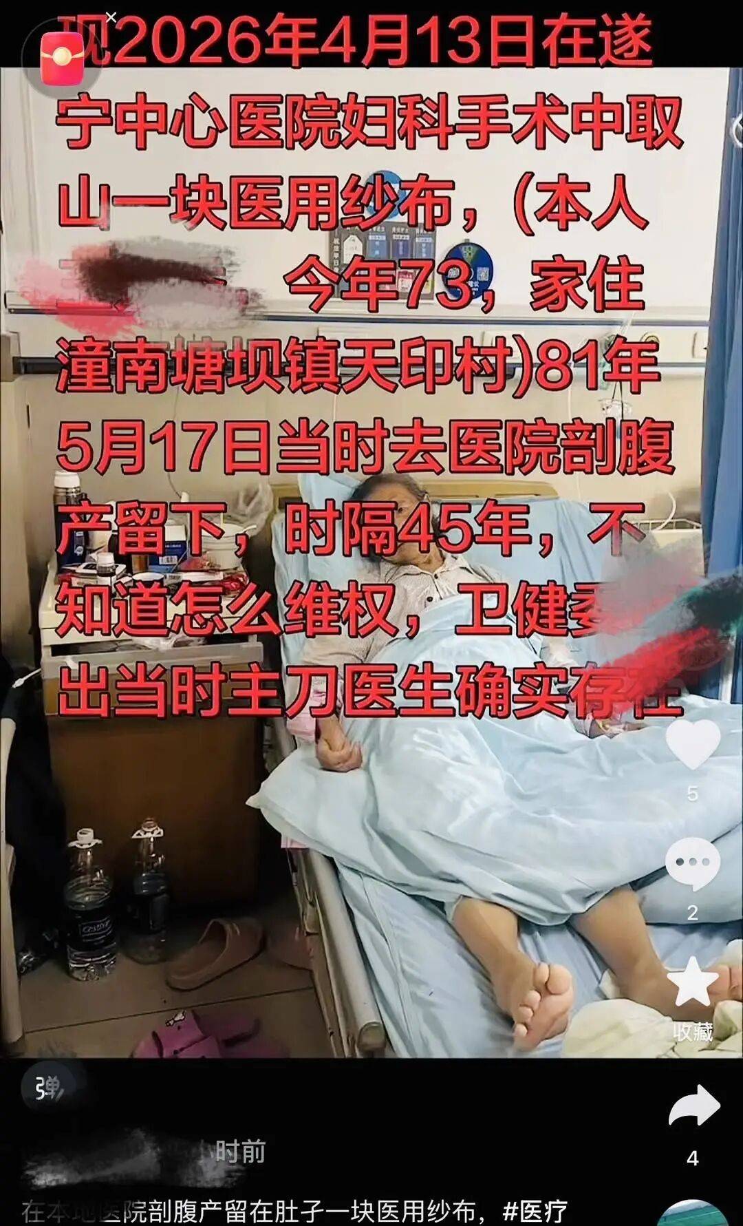 重庆73岁患者体内发现45年前遗留纱布，涉事卫生院：已启动调查，时间久远调查难度大，当年工作的医生一人已离世，另一人长期未回重庆